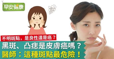 手臂有黑斑|黑斑、臉上皮膚長黑點，是皮膚癌嗎？皮膚科醫師：這…